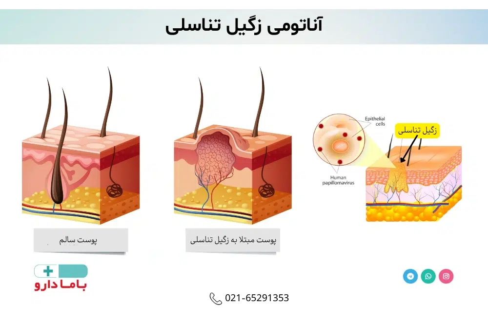 زگیل تناسلی چیست