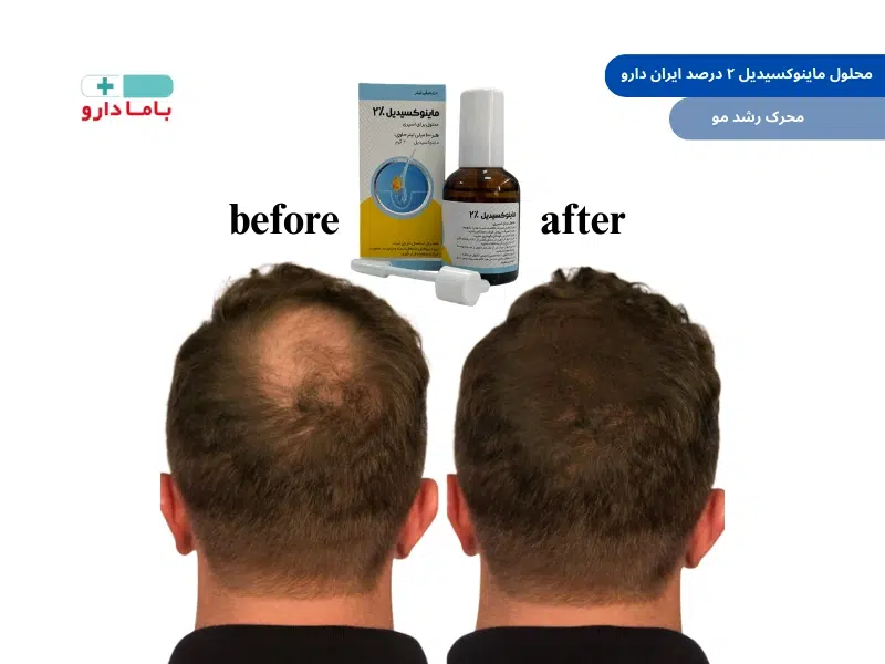 محلول ماینوکسیدیل ایران دارو