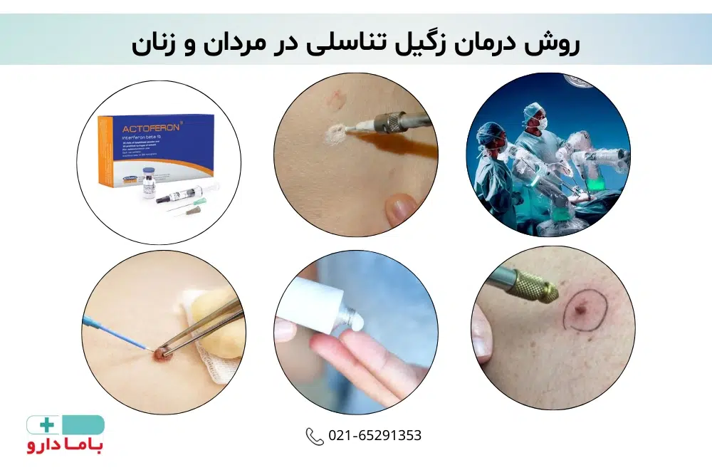 روش درمان زگیل تناسلی در مردان و زنان